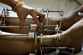 Romperse los huesos para ser más alto, la peligrosa cirugía que triunfa en India