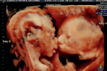 Esta imagen de unas mellizas ‘besándose’ en el vientre busca ser tan viral como el embarazo de Beyoncé