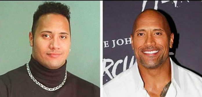 7 famosos antes y después de perder su divina cabellera 