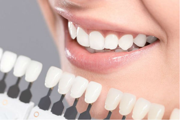 dientes-tratamiento-carillas