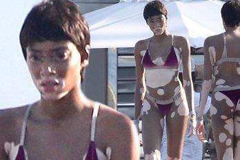 Ni las Kardashian superan a la hermosa modelo que exhibió su cuerpo con vitíligo en bikini